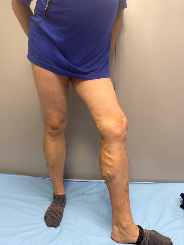 Мази при варикозе не работают