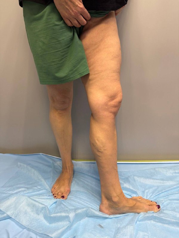 Весна — лучшее время лечить варикоз